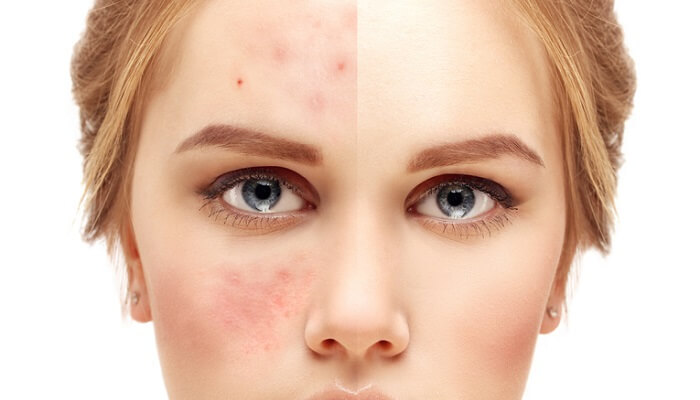 woman with acne and clear skin before and after