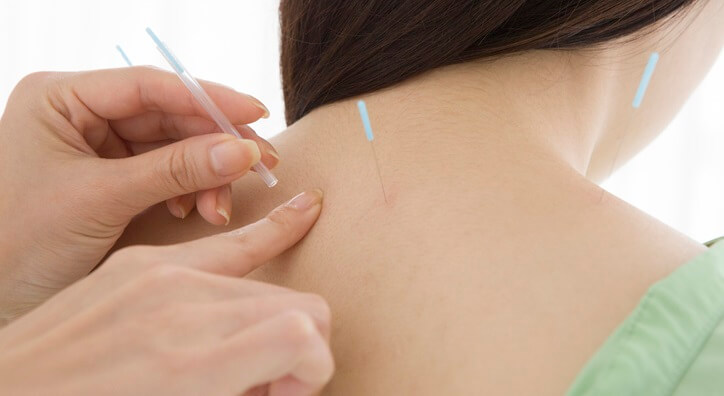 acupuncturist applying needles to woman's back
