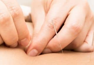 applying acupuncture needles