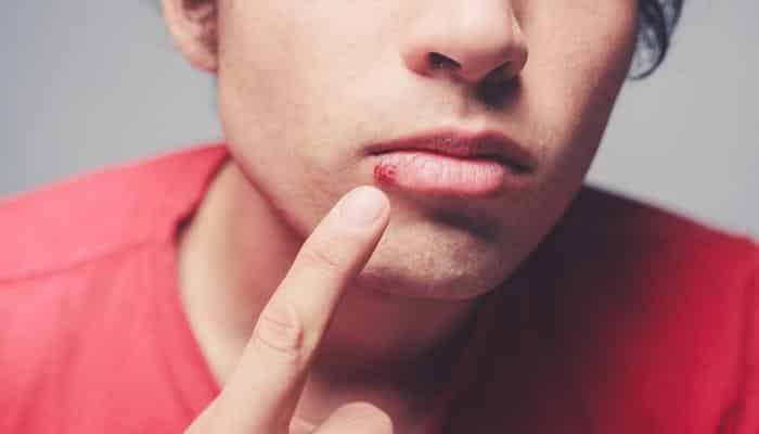 young man pointing at cold sore - essential oils for cold sores