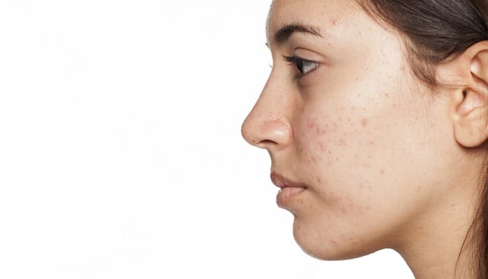 young woman with acne - supplements for acne concept