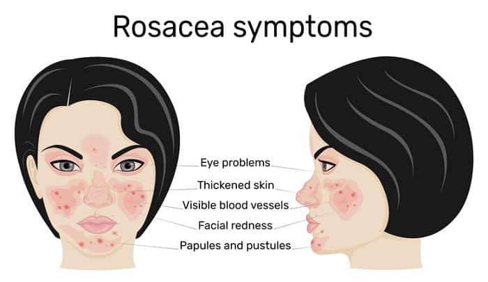 illustration of rosacea symptoms
