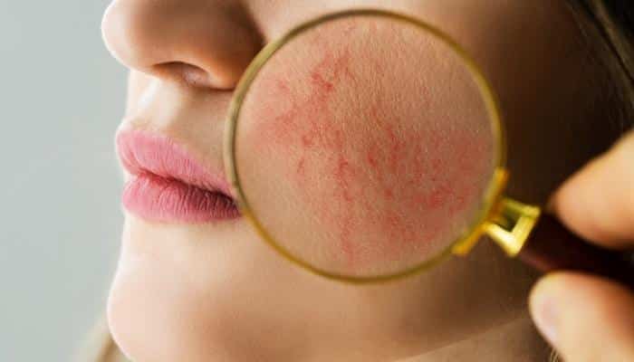 magnifying glass showing rosacea on woman's face
