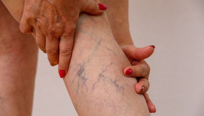 varicose veins on leg - supplements for varicose veins