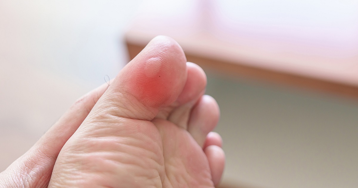 blister on toe - essential oils for blisters